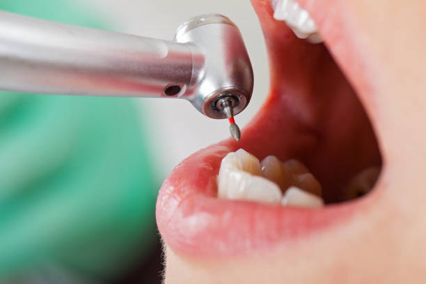 Best Emergency Tooth Extraction in Stanaford, WV